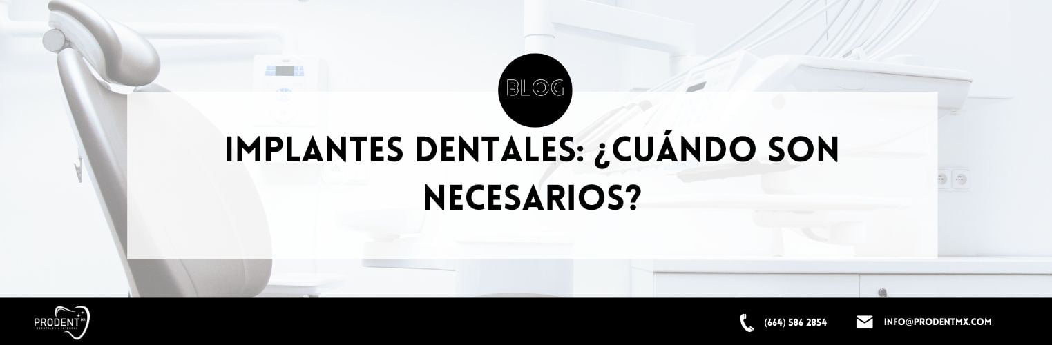 Implantes dentales ¿Cuándo son necesarios